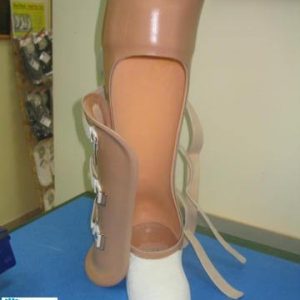 פרוטזה לרגל סיימס