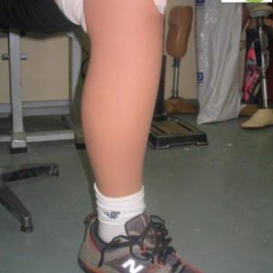 ציפוי קוסמטי לתותבת לרגל