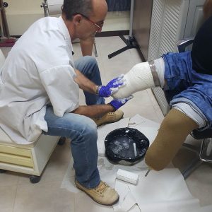 לקיחת מידות גבס לתותבות מתחת לברך