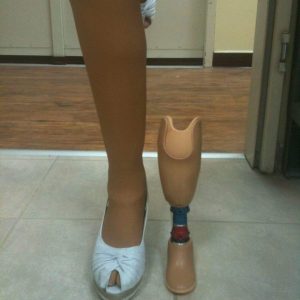 תותבת רגל לתינוק