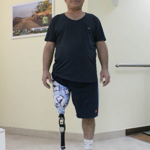 פרוטזה מעל הברך עם TOTAL KNEE